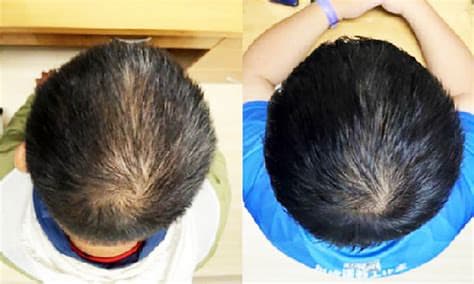 Scientists Invent Plant-Based Serum Proven to Regrow Hair in Weeks